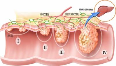 驚!16歲少女得「大腸癌」晚期!原因竟是平常的這個習慣...很多人都會這樣,一定要分享出去!