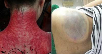 小心!!「中暑」別亂刮痧!!少女身上竟刮出「可怕的足球」…原因嚇死人了!!