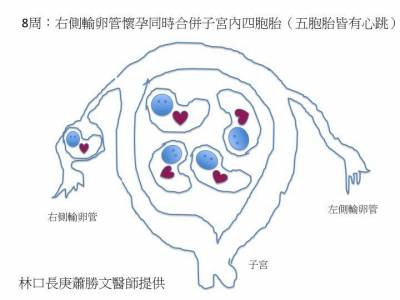 亞洲首例! 罕見5胞胎異位懷孕