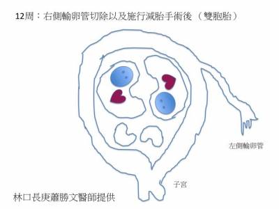 亞洲首例! 罕見5胞胎異位懷孕