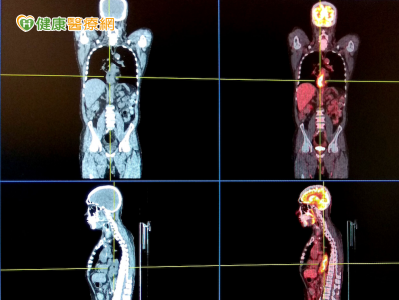 4D電腦斷層掃描儀 讓腫瘤無所遁形