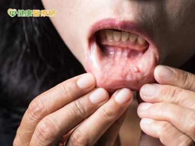 口腔癌徵兆不痛不癢 4成拖到晚期
