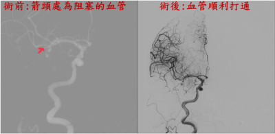 雙向數位血管X光機 中國醫藥大學新竹附設醫院成功搶救87歲腦中風病患