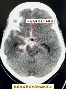 微創血管內栓塞手術中國醫藥大學新竹附設醫院成功搶救顱內動脈瘤病患