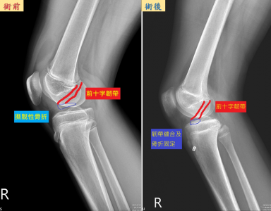 解封後學童運動骨折增多 中國醫藥大學新竹附設醫院骨科醫師陳威仁三點提醒