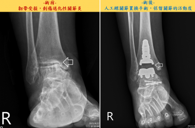 65歲婦跛腳走路無法貼地 人工踝關節置換手術恢復行走