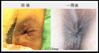 【張伸吉醫師】《新型雙極雷射痔瘡手術》談談原理及臨床成果