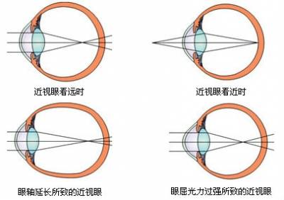 高度近視也不用帶眼鏡了:請轉給身邊近視的朋友!