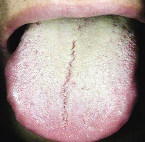 得了胃癌症舌头图片图片