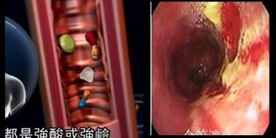 太嚇人 這名男子以99 人都會用的方式吞藥~居然食道爛掉險慘死 最後竟切某個部位來取代
